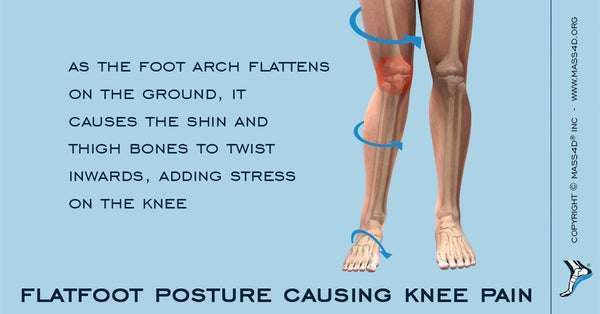 How Flat Feet Can Cause Knee Pain