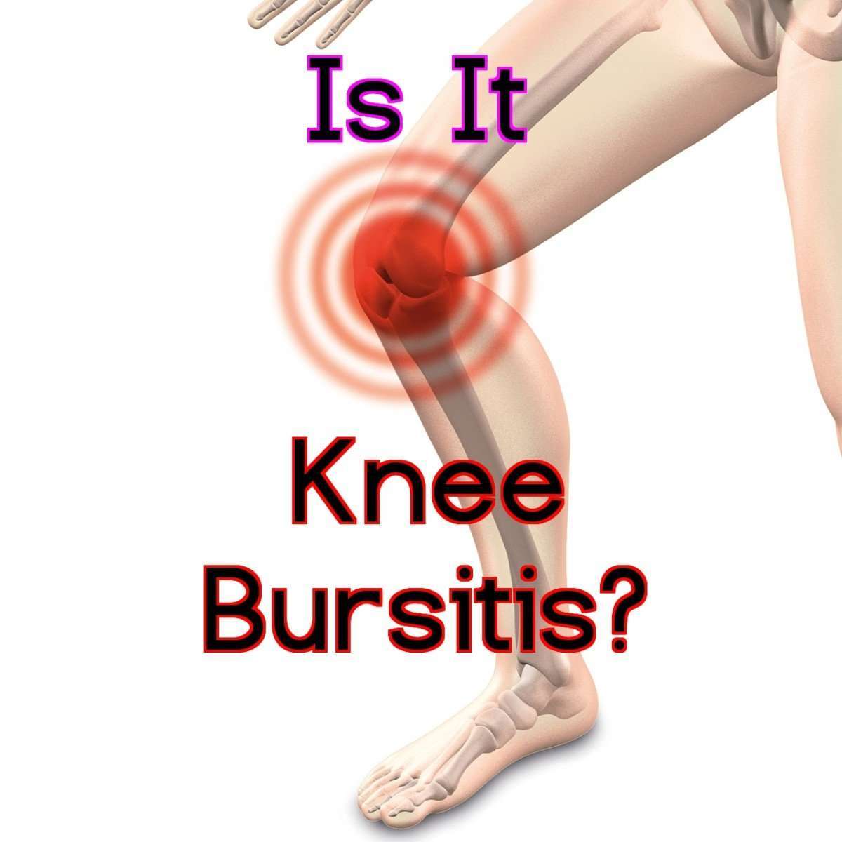 How I Managed My Knee Bursitis Symptoms: Best Treatment ...