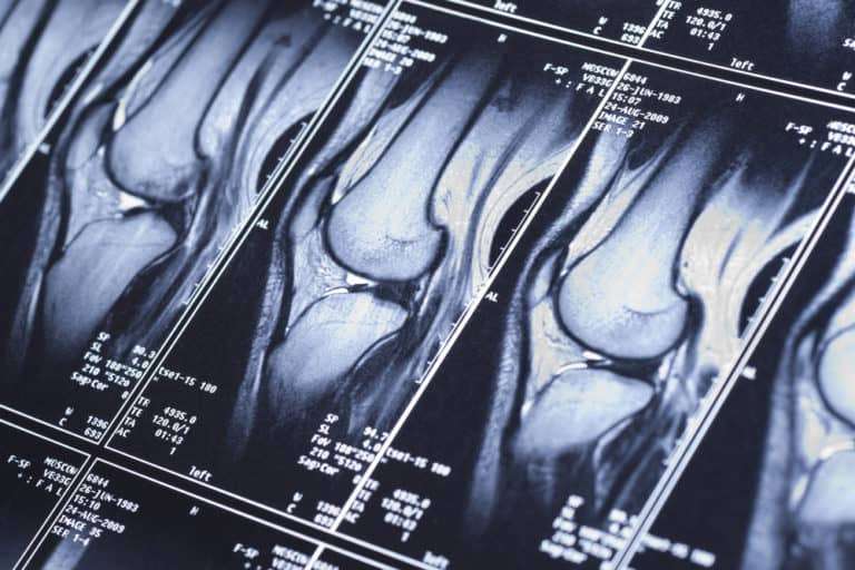 How Long Does a Knee MRI Take?