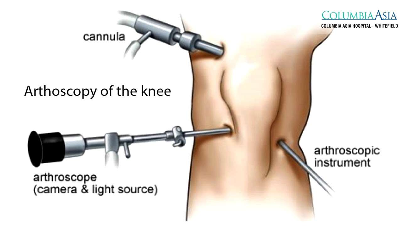 How long does it take to recover from Arthroscopic Knee Surgery?