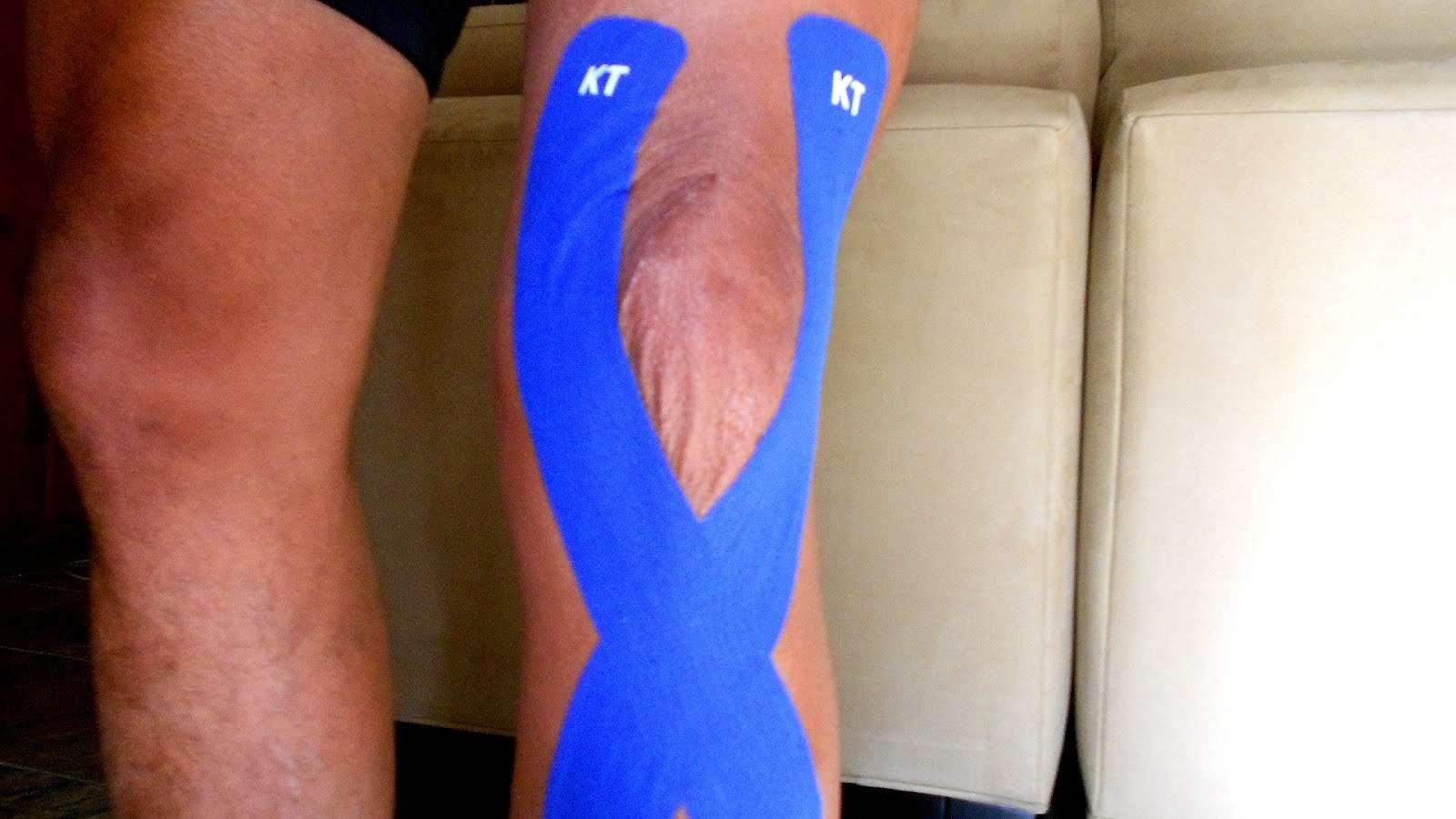 How Long Does Swelling Last After Knee Replacement Surgery