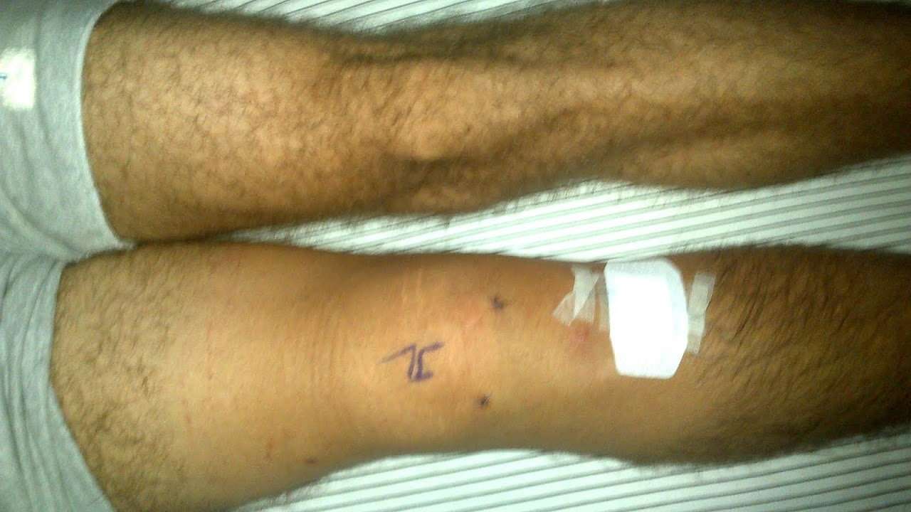 How Long Does Swelling Last After Knee Surgery