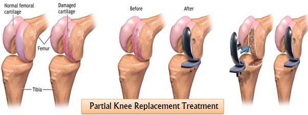 How much does a partial knee replacement cost in India ...