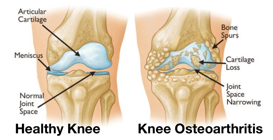 HOW TO AVOID A KNEE REPLACEMENT