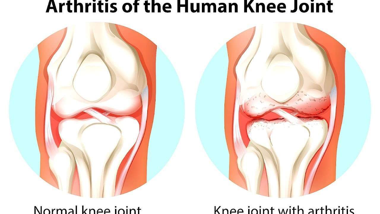 How To Deal With Arthritis In The Knee