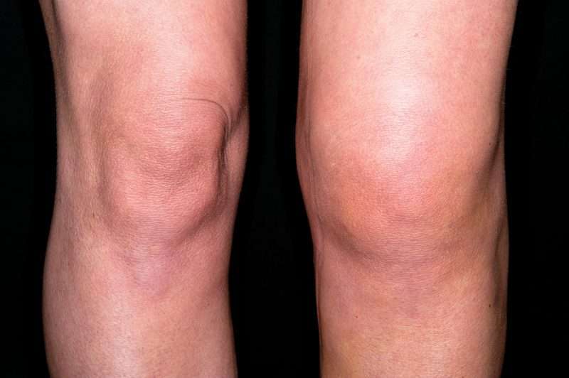 How to Decrease Swelling After Knee Surgery for A Quicker ...