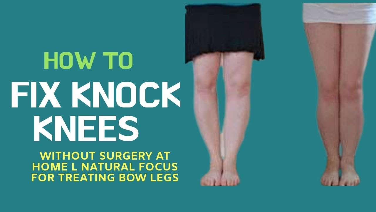 How to Fix Knock Knees without surgery at Home l Natural Focus for ...