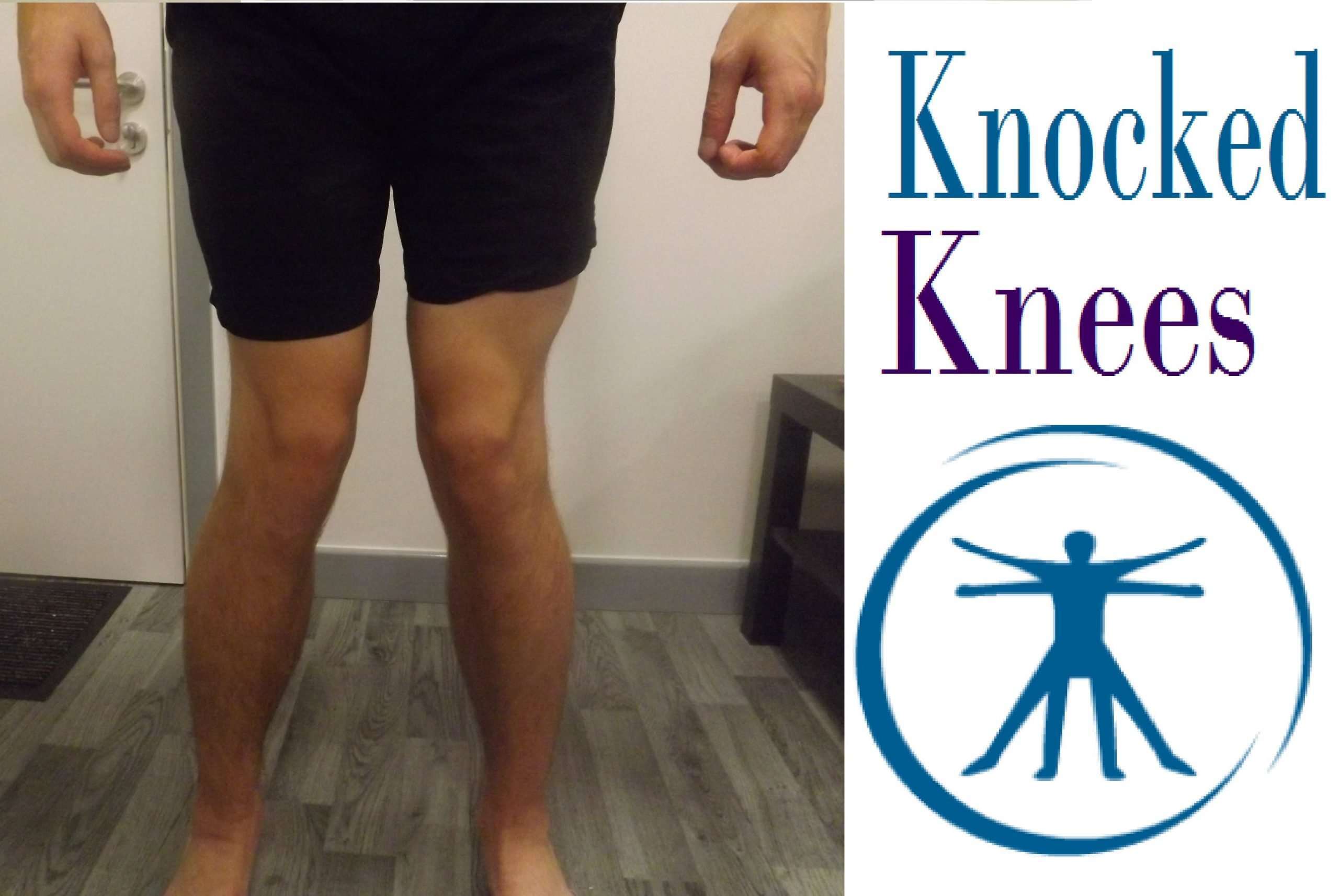 How To Fix Knocked Knees (Genu Valgum) With Correction ...