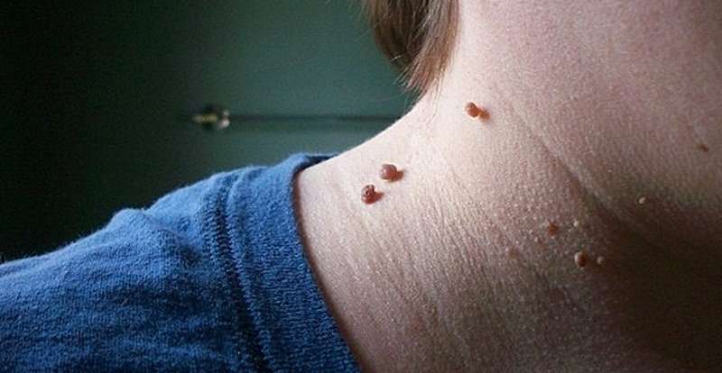 How to get rid of a warts in one day from the skin with a ...