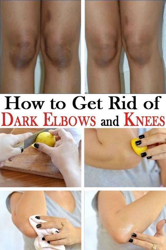 How To Get Rid Of Dark Elbows And Knees Naturally