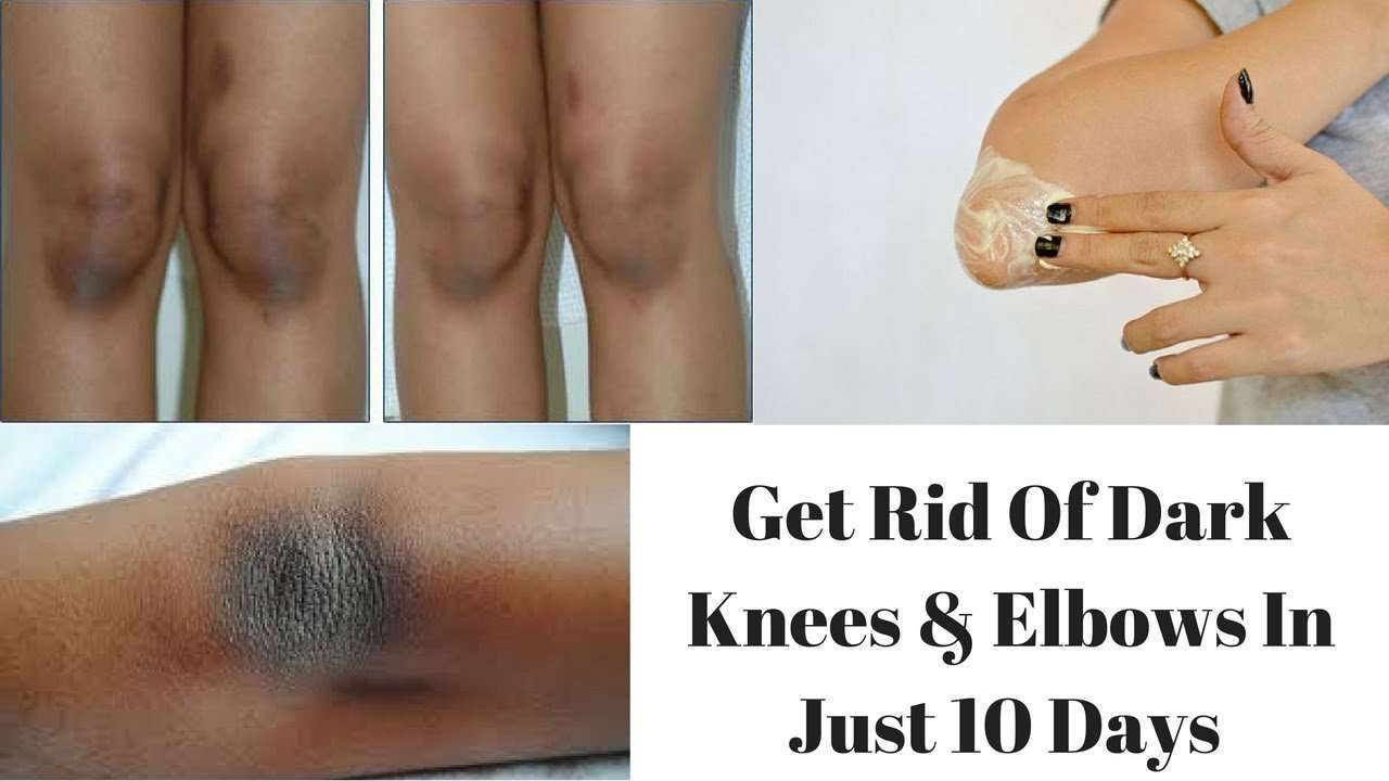 How to Get Rid of Dark Elbows and Knees