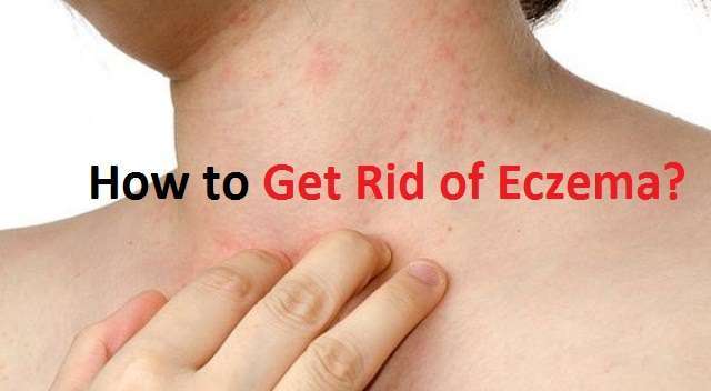 How to Get Rid of Eczema?
