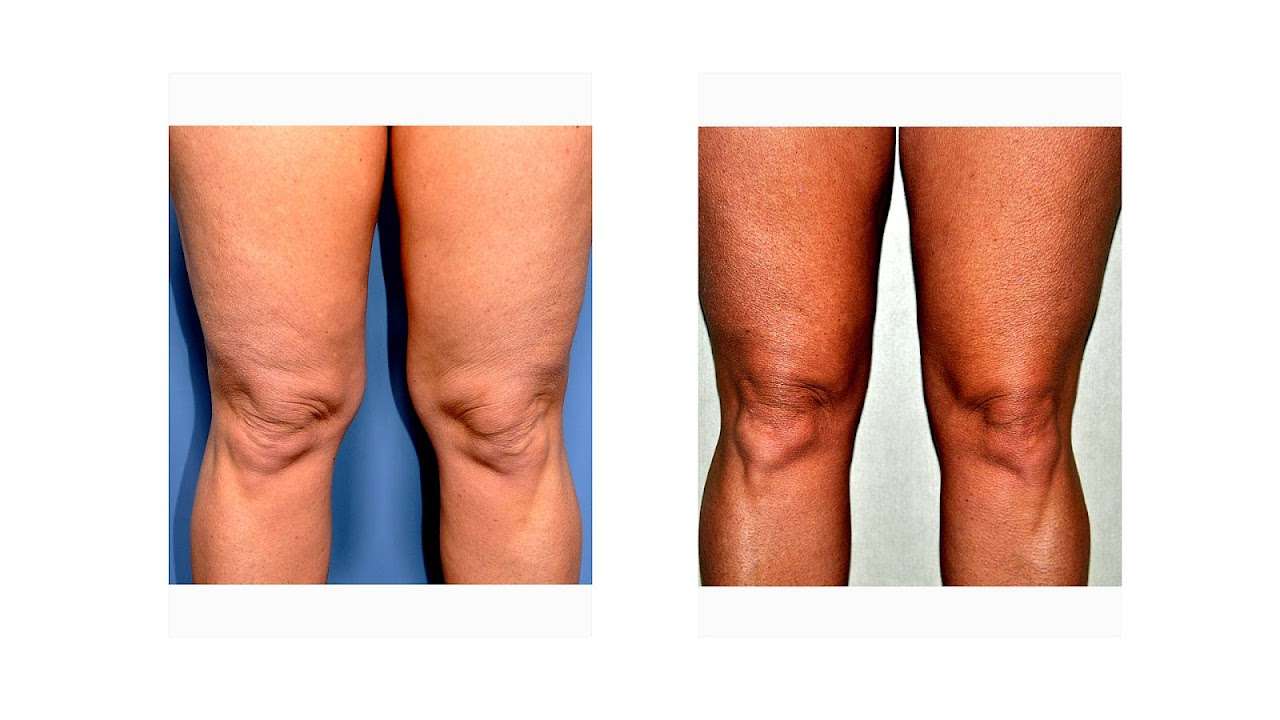How To Get Rid Of Fat Behind Knees