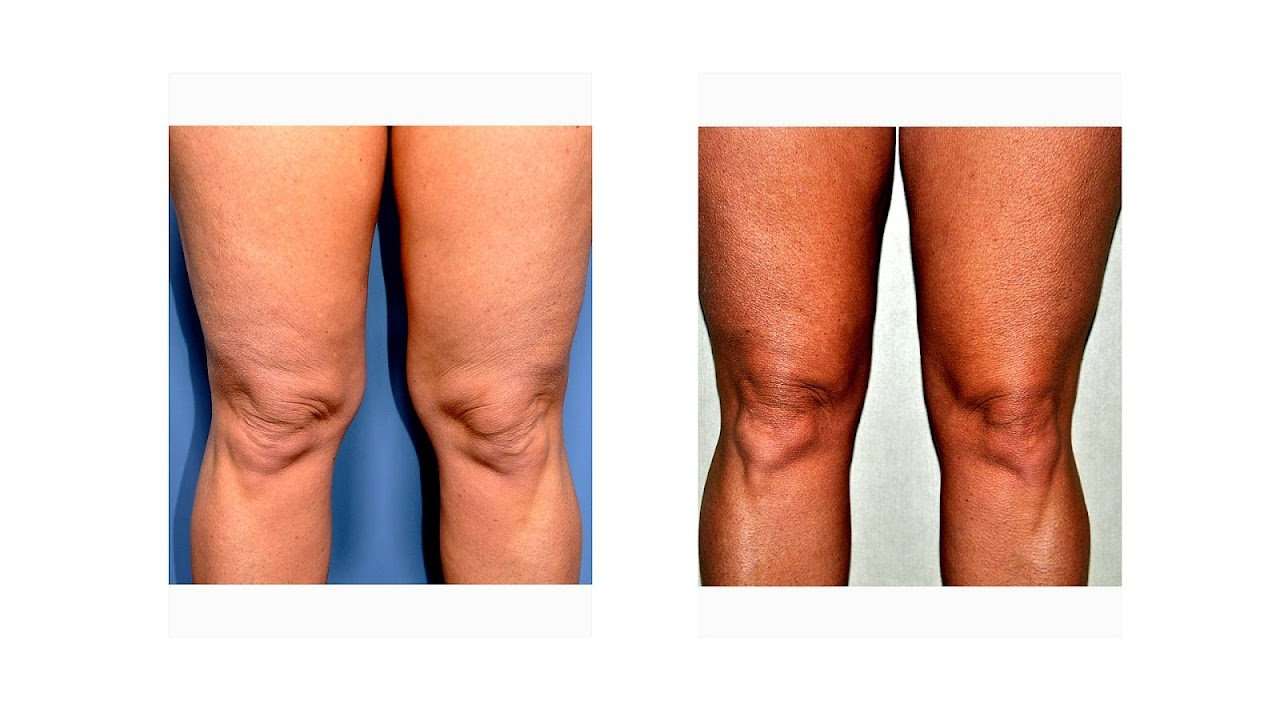 How To Get Rid Of Knee Fat
