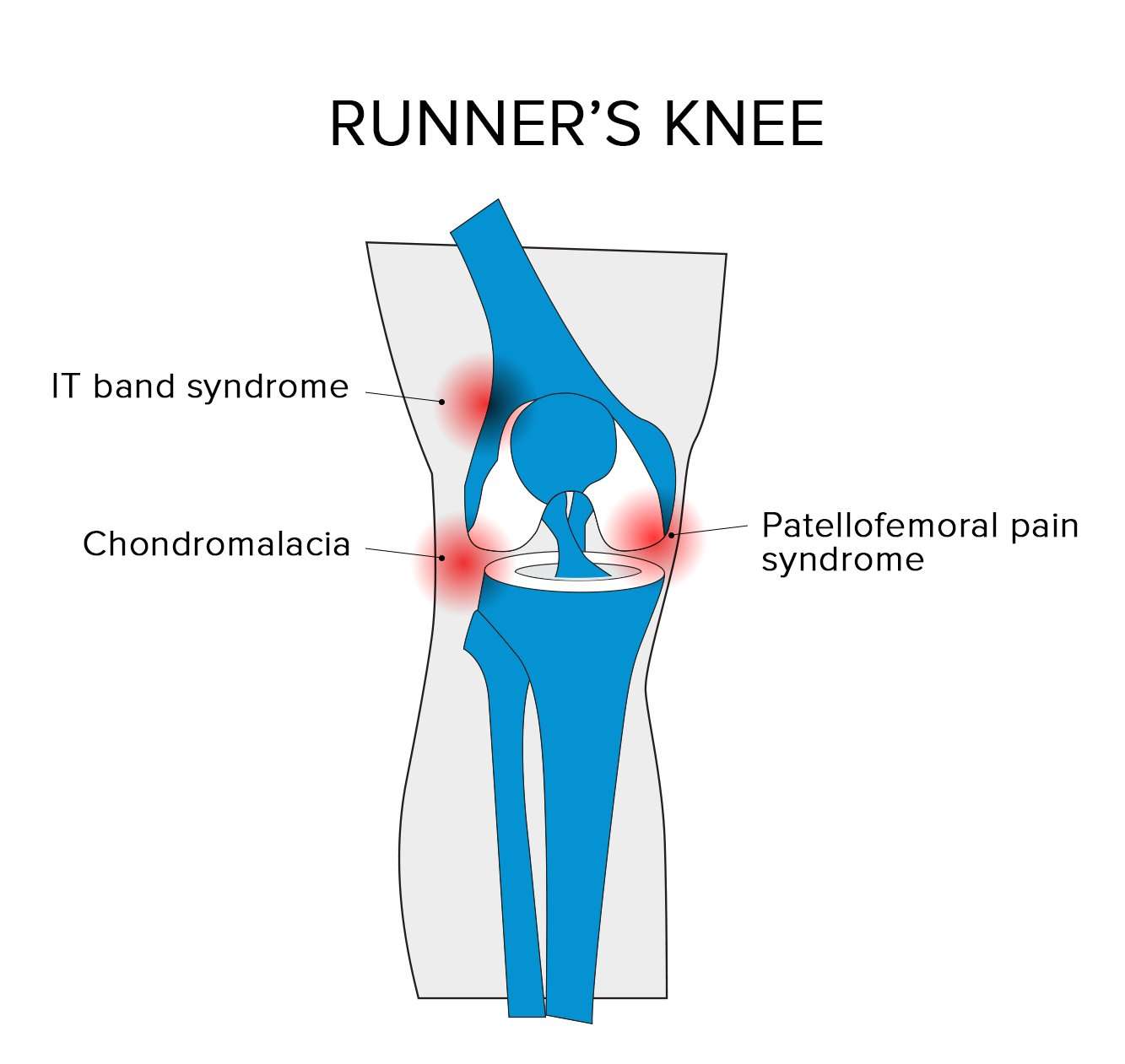 How To Get Rid Of Knee Pain After Exercise