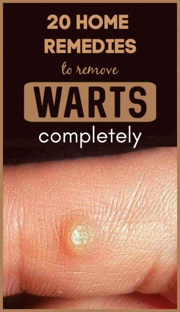 How To Get Rid Of Warts  Home Remedies &  More #warts # ...
