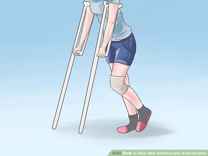 How to Heal after Arthroscopic Knee Surgery: 12 Steps