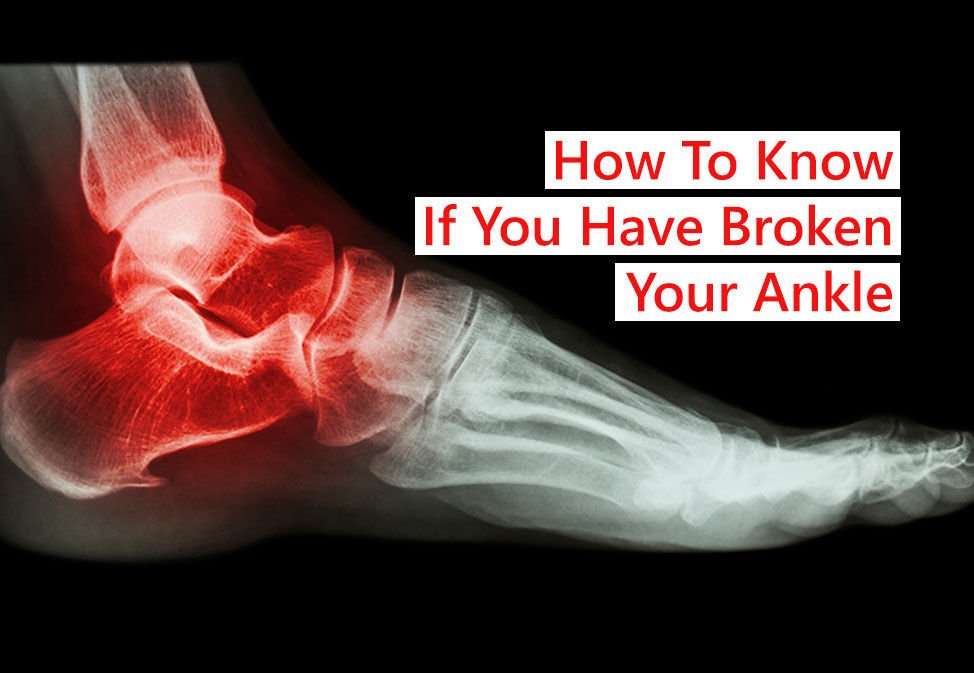 How to know if you have broken your ankle