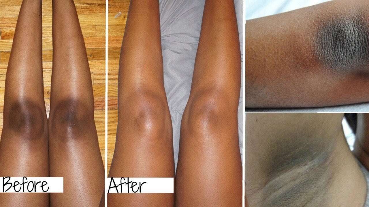 How to lighten Dark Elbows and Dark Knees Easily at Home ...