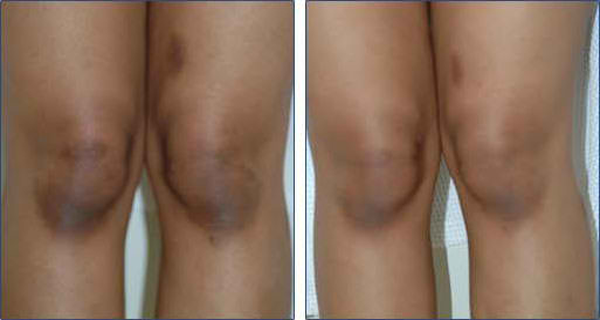 How To Lighten Dark Knees And Elbows Naturally!