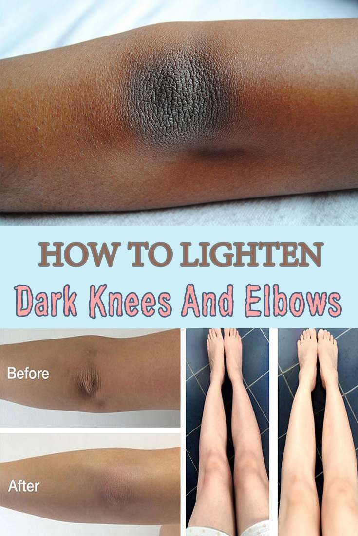 How to lighten dark knees and elbows