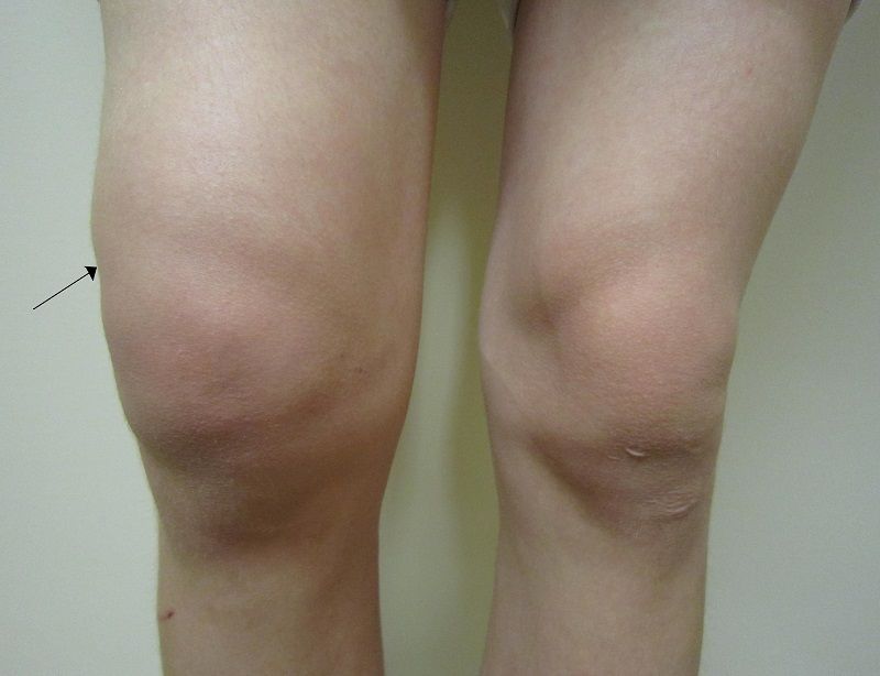 How to Manage Pain Swelling and Bruising After Total Knee ...