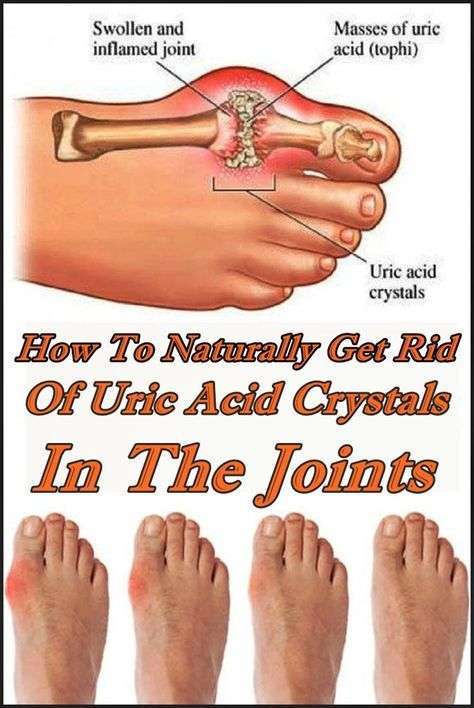 How To Naturally Get Rid Of Uric Acid Crystals In The Joints