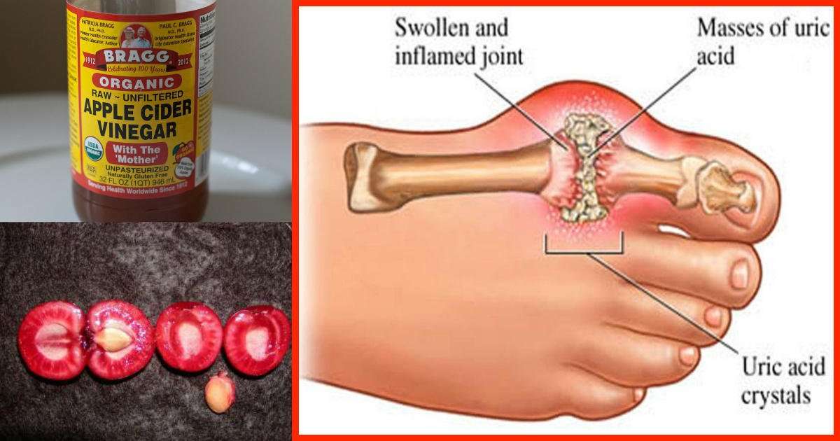 How To Quickly Remove Uric Acid Crystallization From Your Body To ...