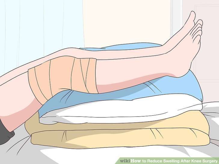 How to Reduce Swelling After Knee Surgery: 11 Steps