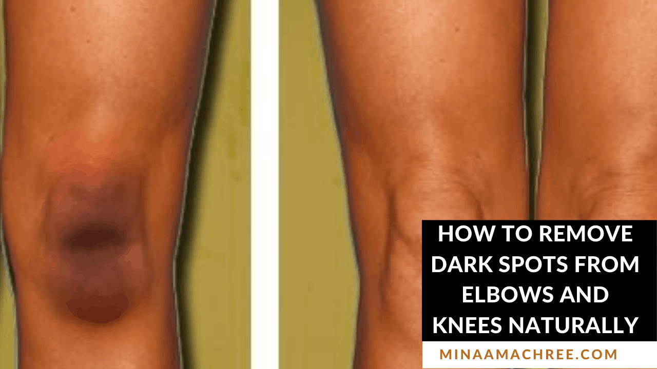 How To Remove Dark Spots From Elbows And Knees Naturally ...