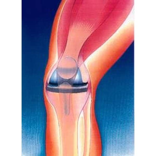 How to Survive a Total Knee Replacement