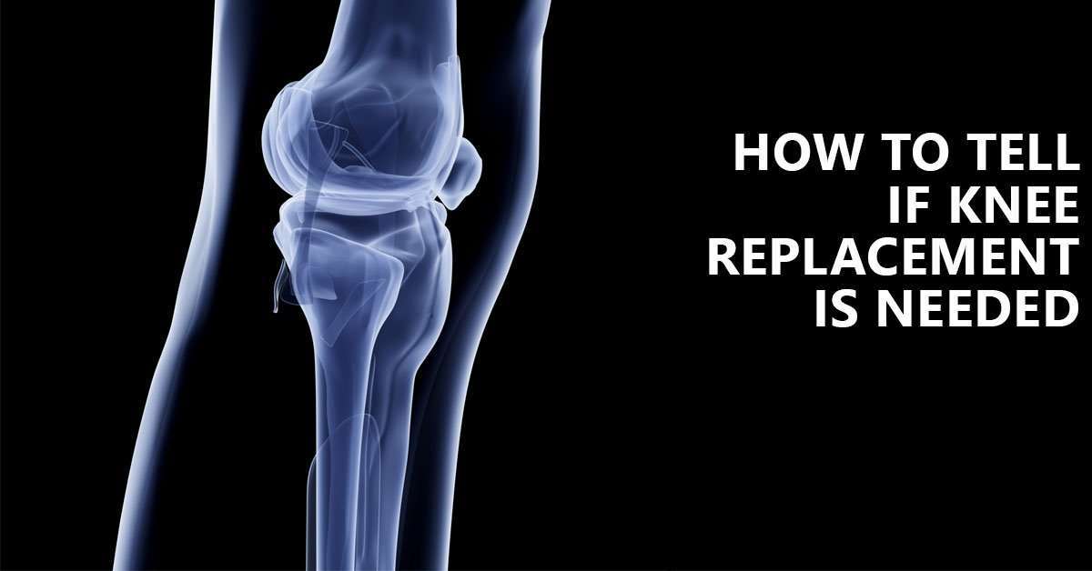 How to Tell if Knee Replacement is Needed  ProCare Home ...