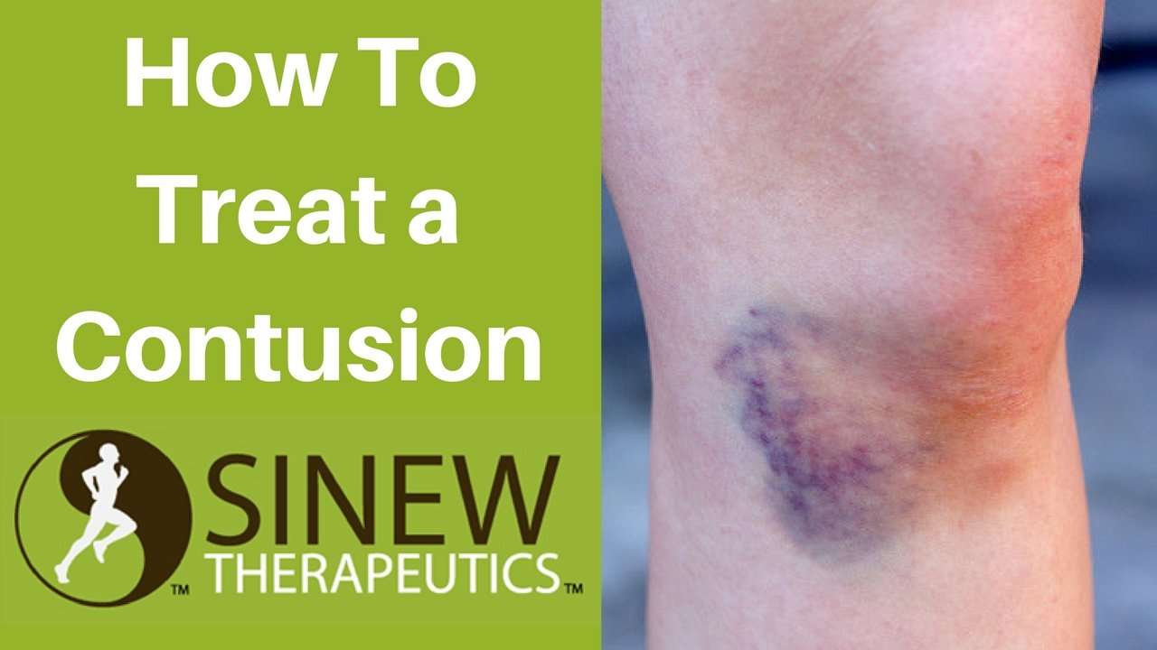 How To Treat a Contusion and Speed Recovery