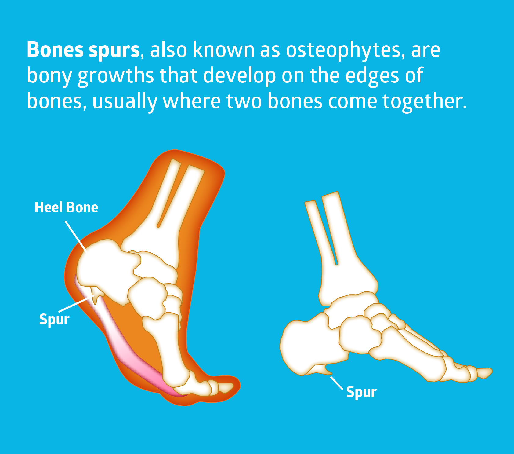 How to Treat Bone Spurs The Natural Way