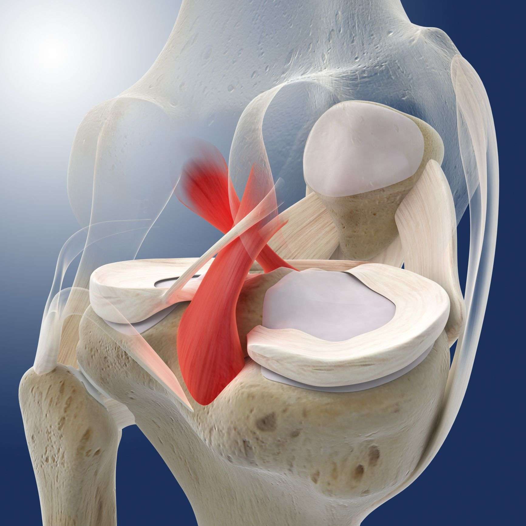 How to Treat the Painful Injury of a Posterior Cruciate ...