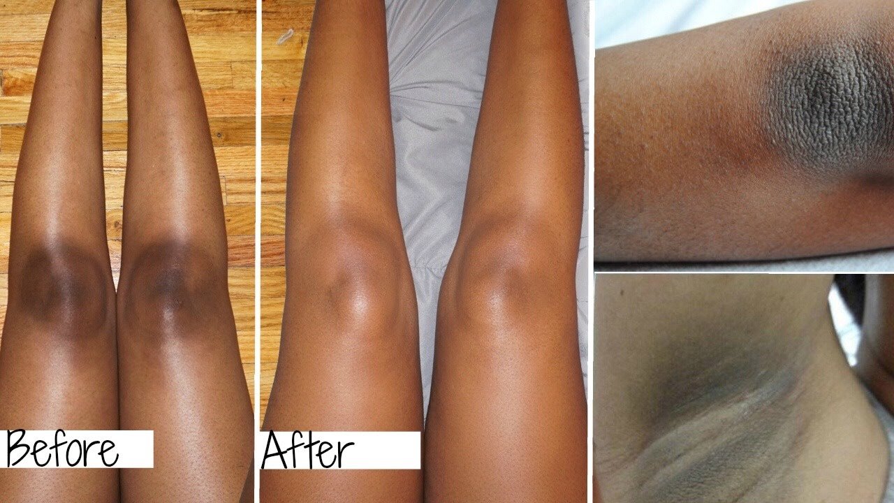 HOW TO WHITEN DARK ELBOWS, UNDERARMS AND KNEE EASILY AT ...