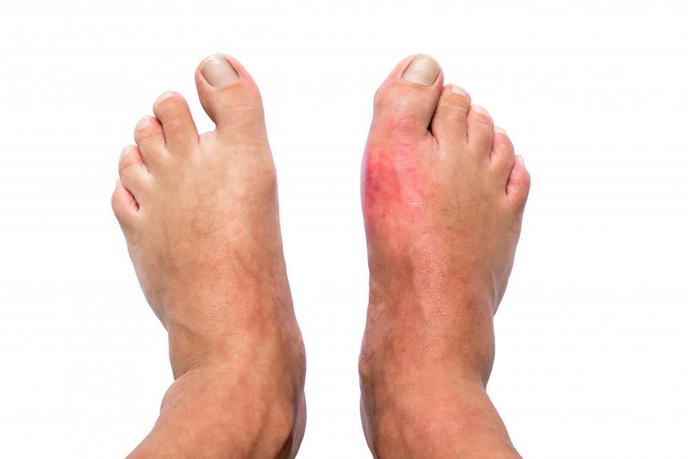 How You Can Protect Your Joints From the Effects of Gout ...