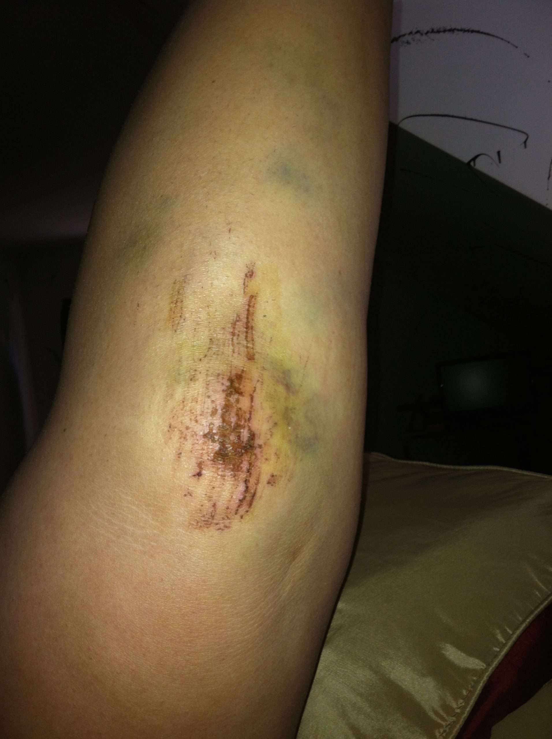 Hurt my knee â Danielle Lombardo