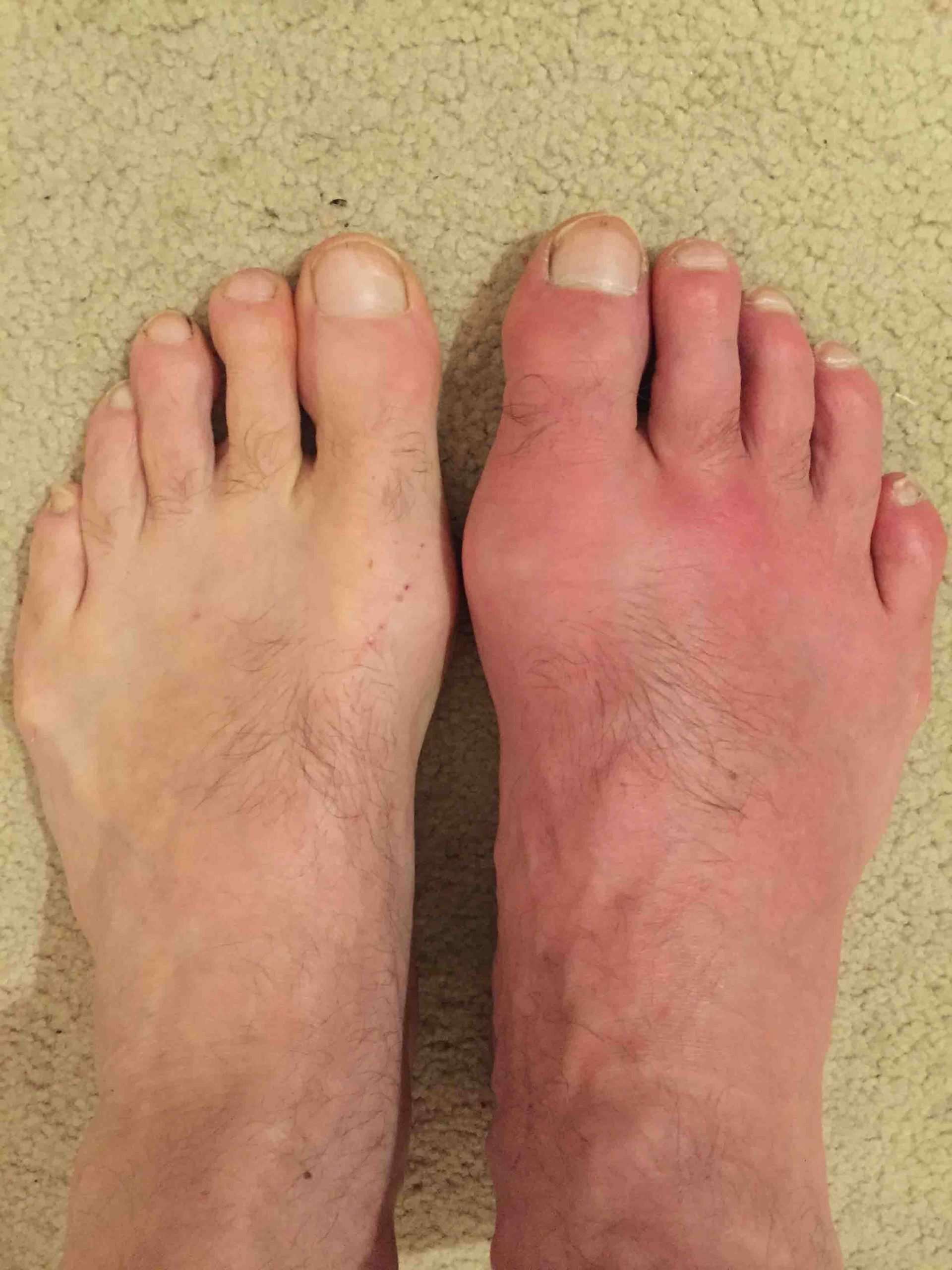 images of gout