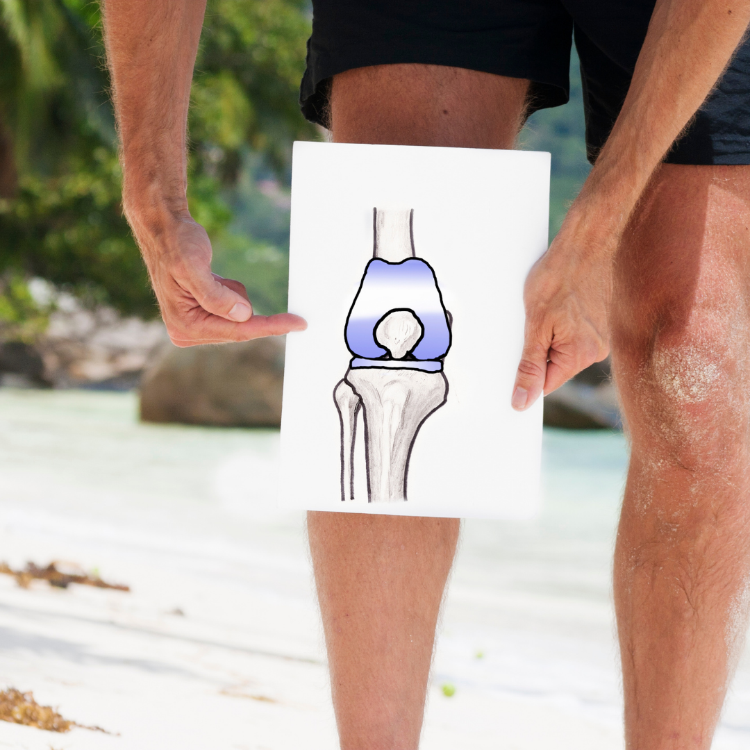 Important Exercises to Do Before a Knee Replacement