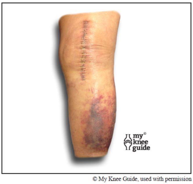 Incision healing after knee replacement surgery