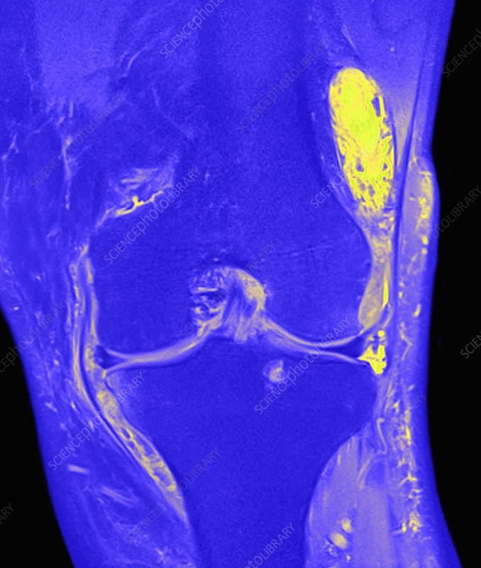 Infected knee joint, MRI scan