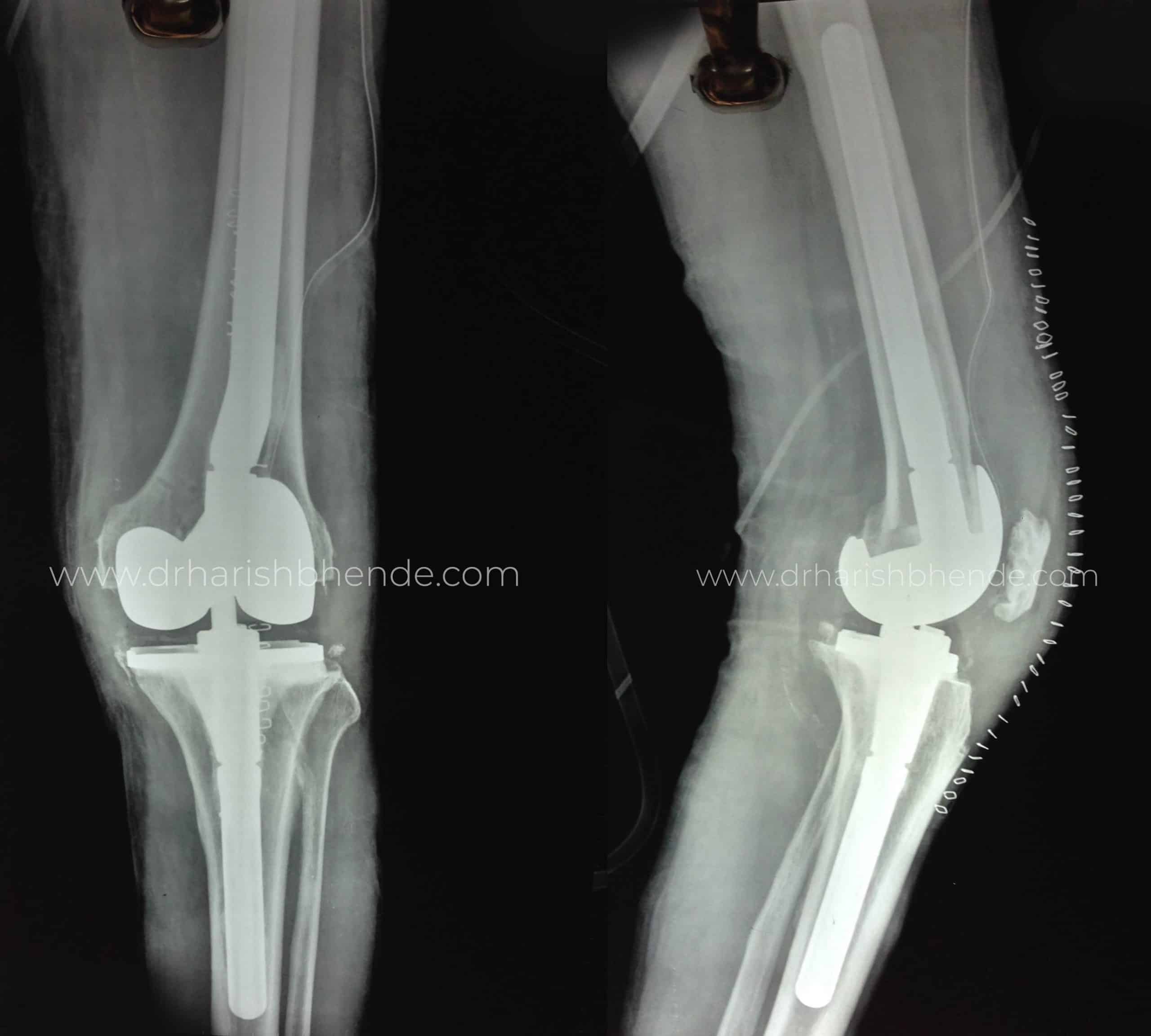 Infected old Knee Replacement  2 stage Revision Knee Replacement