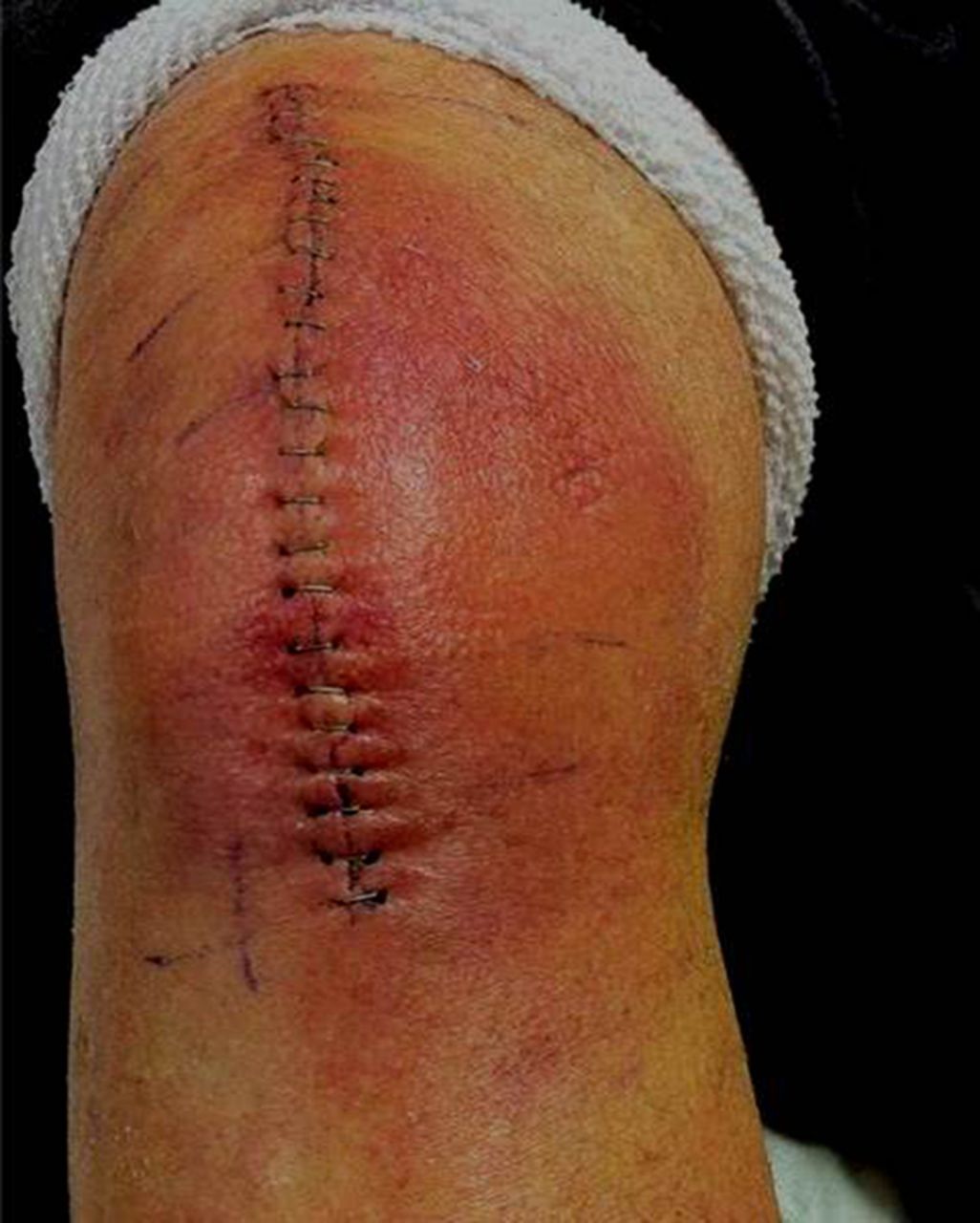 Infection after knee replacement pictures  Exurt
