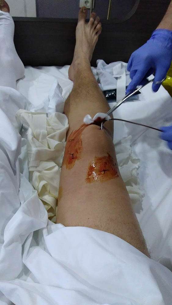 Injury Log Part II  Knee Surgery  Andrei