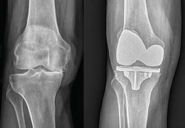 Innovative Therapies Enhance Results of Total Knee ...