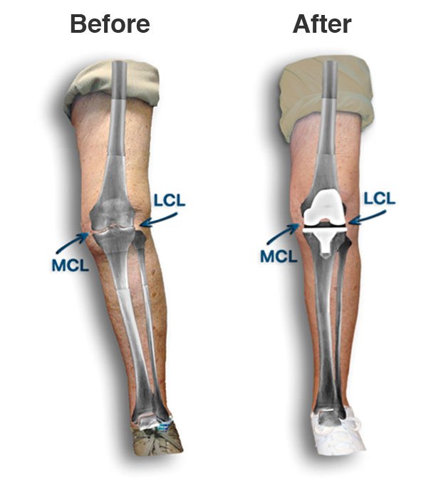 Inside Knee Pain When Straightening Leg