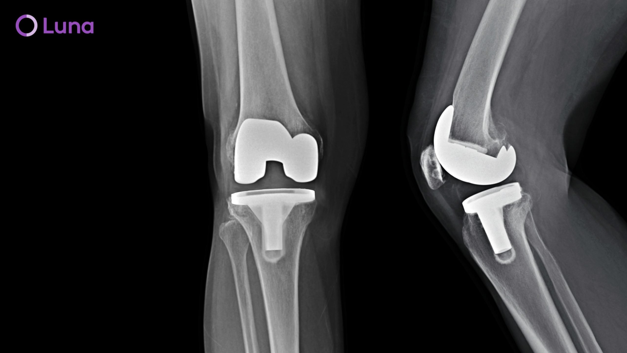 Is Knee Replacement Surgery Right for You?