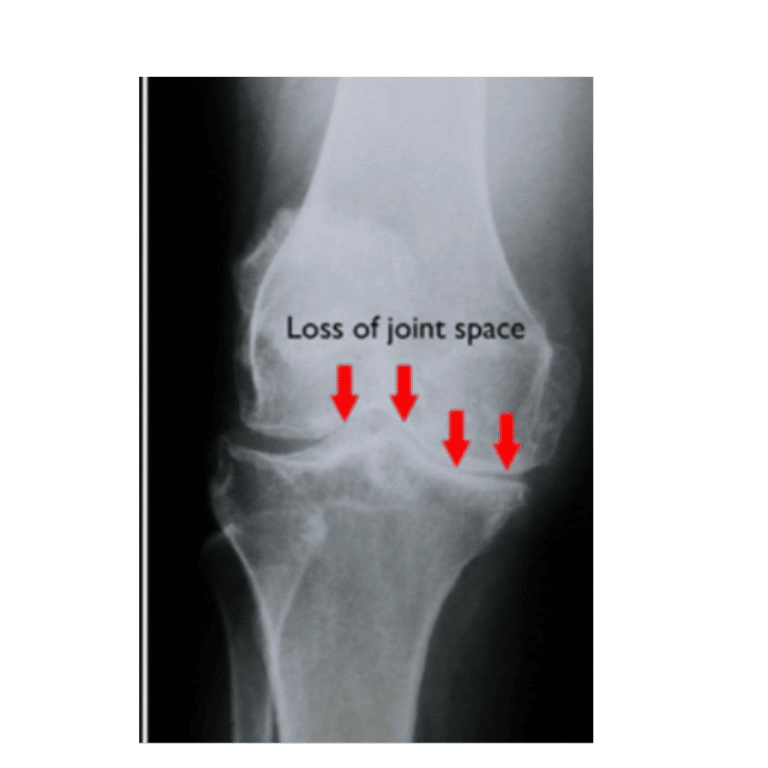 Is Knee Replacement Worth It?