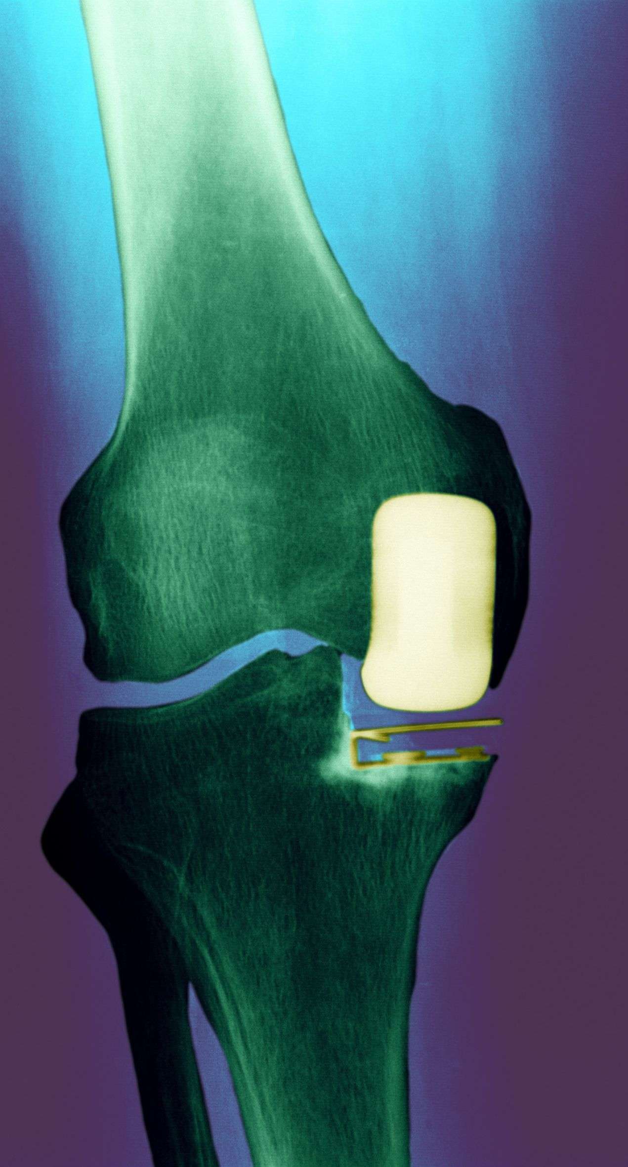 Is Partial Knee Replacement Surgery Right for You?